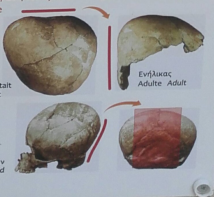 Deformlt koponyk Ciprus szigetn